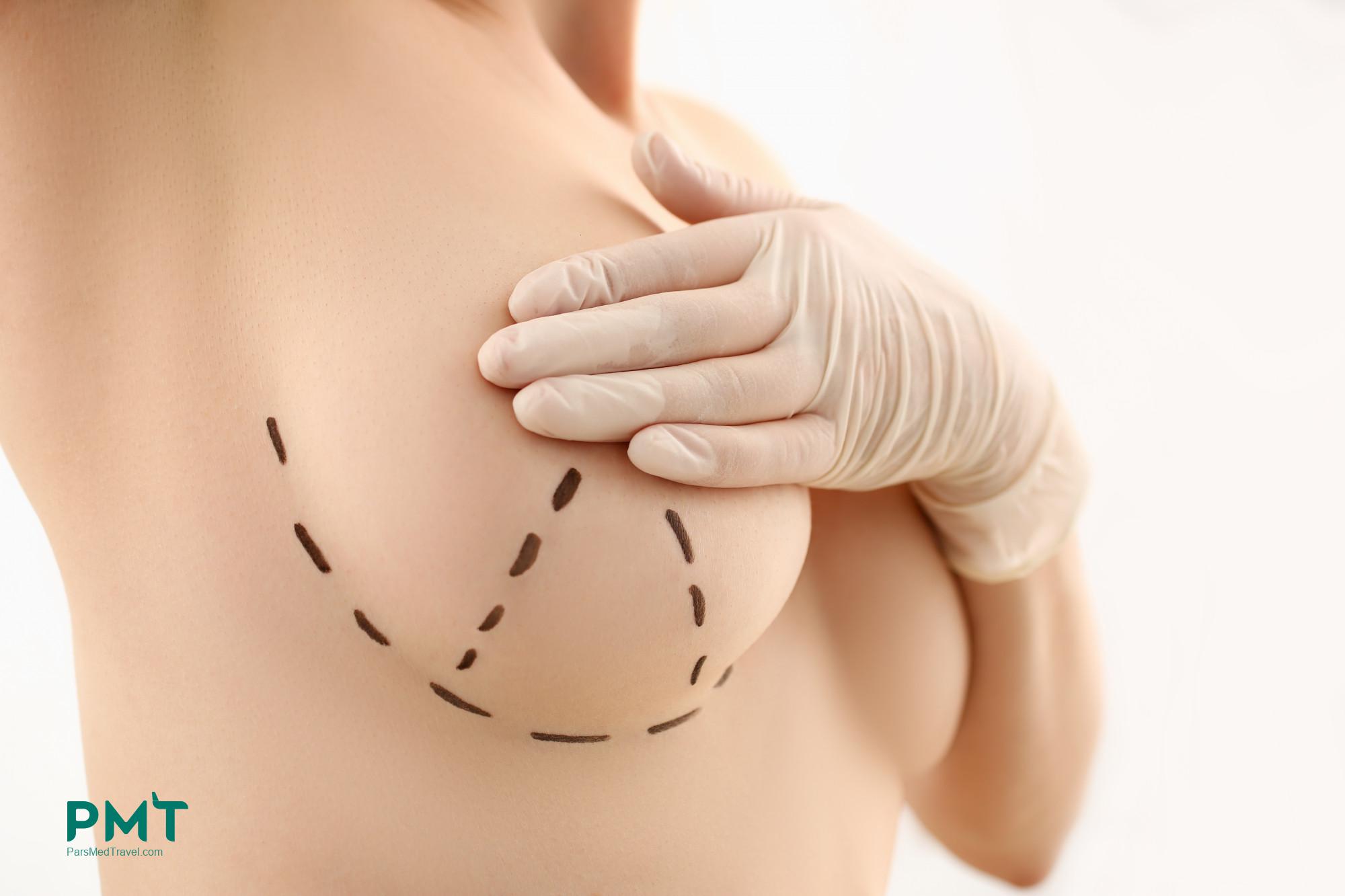 Breast Augmentation & Cosmetic dentistry in Iran with medical tourism guide & best price 2024