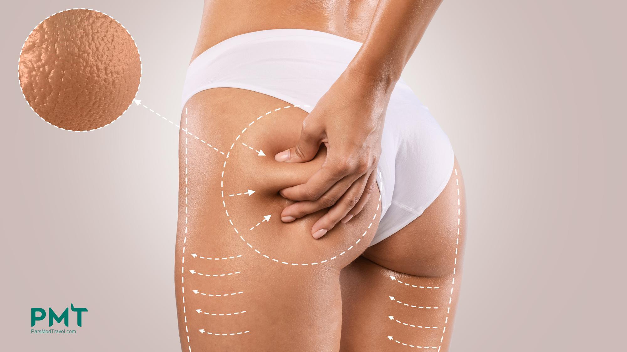 Butt cosmetic surgery & lift in iran | medical tourism guide & best price with parsmedtravel 2024