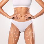 Change Your Body with Liposuction in Iran