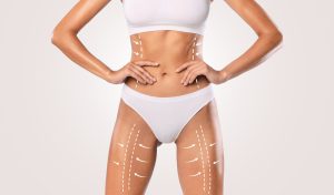 Change Your Body with Liposuction in Iran