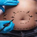 liposuction-body-transform