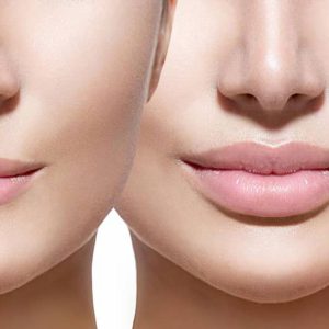 Central lip lift Cost & Surgeons in Iran