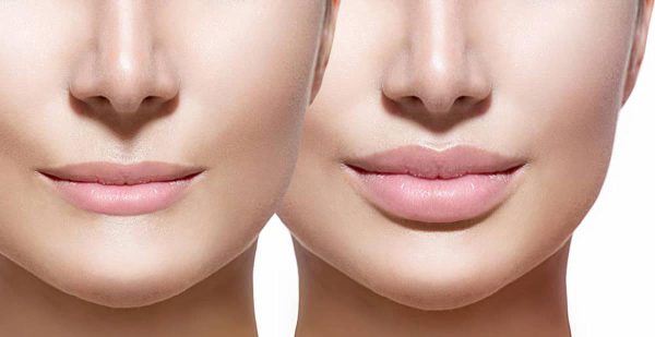 Central lip lift Cost & Surgeons in Iran