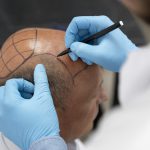 Hair Transplants in Iran - with Pars Med Travel