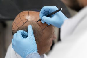Hair Transplants in Iran - with Pars Med Travel