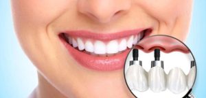 طب الأسنان التجميلي في إيران-pmt