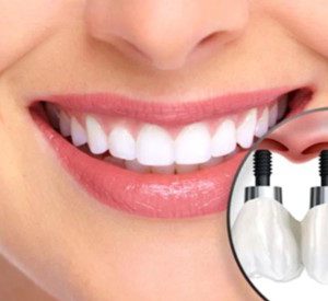 dental-implant-pars-med-travel