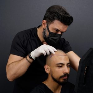 Hair transplant in Iran-pmt
