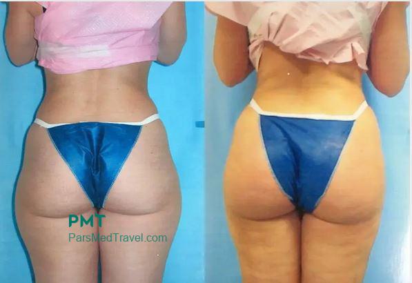 Buttock fat injection in Iran-pmt
