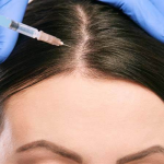 The best Hair mesotherapy in Iran-pmt