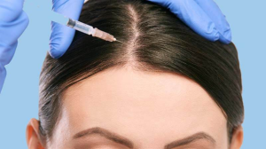 The best Hair mesotherapy in Iran-pmt