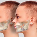Jaw angle prosthesis-pmt