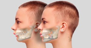 Jaw angle prosthesis-pmt