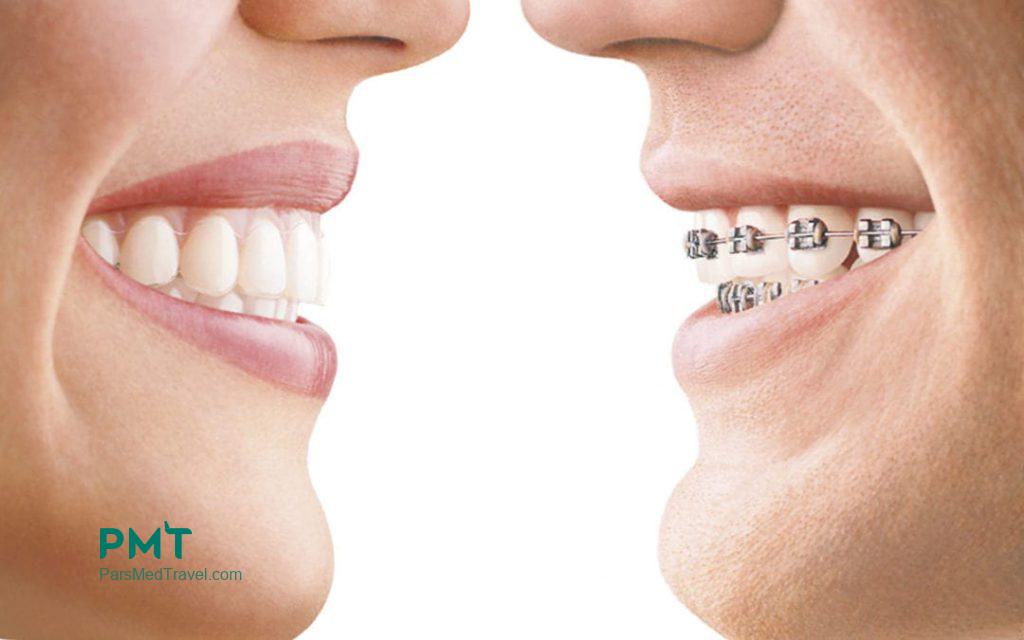 Aesthetic Smiles Through Invisible Orthodontics in Iran-pmt
