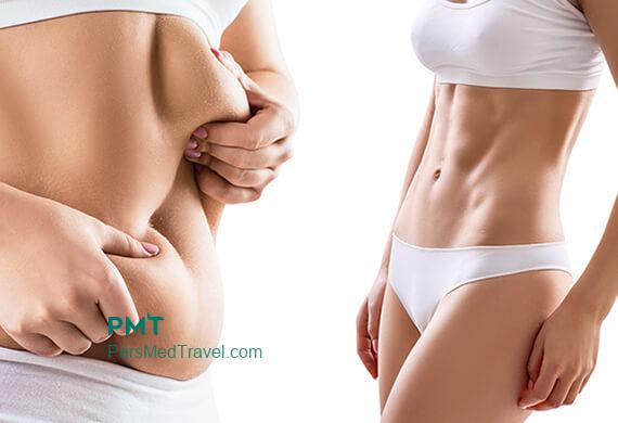 Fix all abdominal beauty problems with one surgery in Iran-pmt