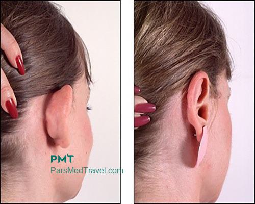 Otoplasty is a way to listen to the needs of your ears in Iran-pmt