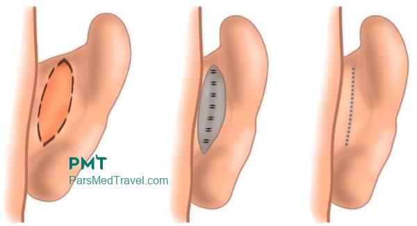Otoplasty is a way to listen to the needs of your ears in Iran-pmt