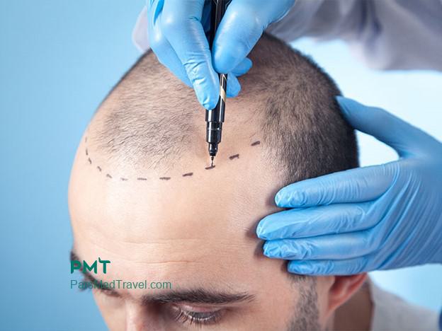 Rejuvenate with natural hair transplant In Iran-pmt