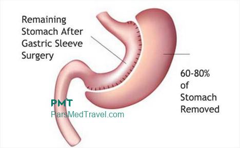 Easy weight loss with stomach sleeve in Iran-pmt