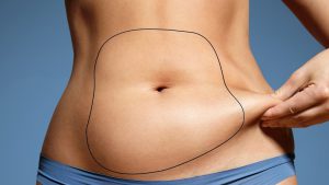 Flat and beautiful belly with liposuction-pmt
