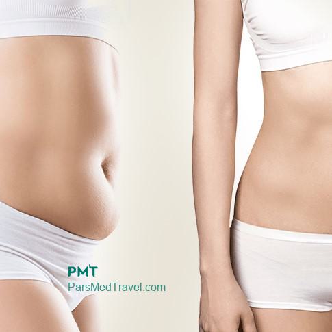 Flat and beautiful belly with liposuction-pmt