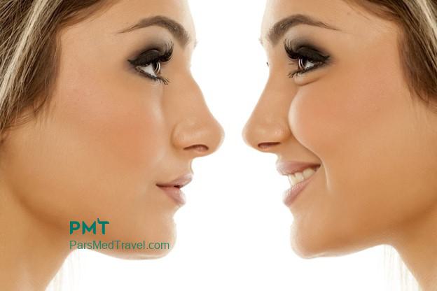 Beautiful and attractive nose with rhinoplasty-pmt