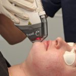Beauty with fractional laser device-pmt