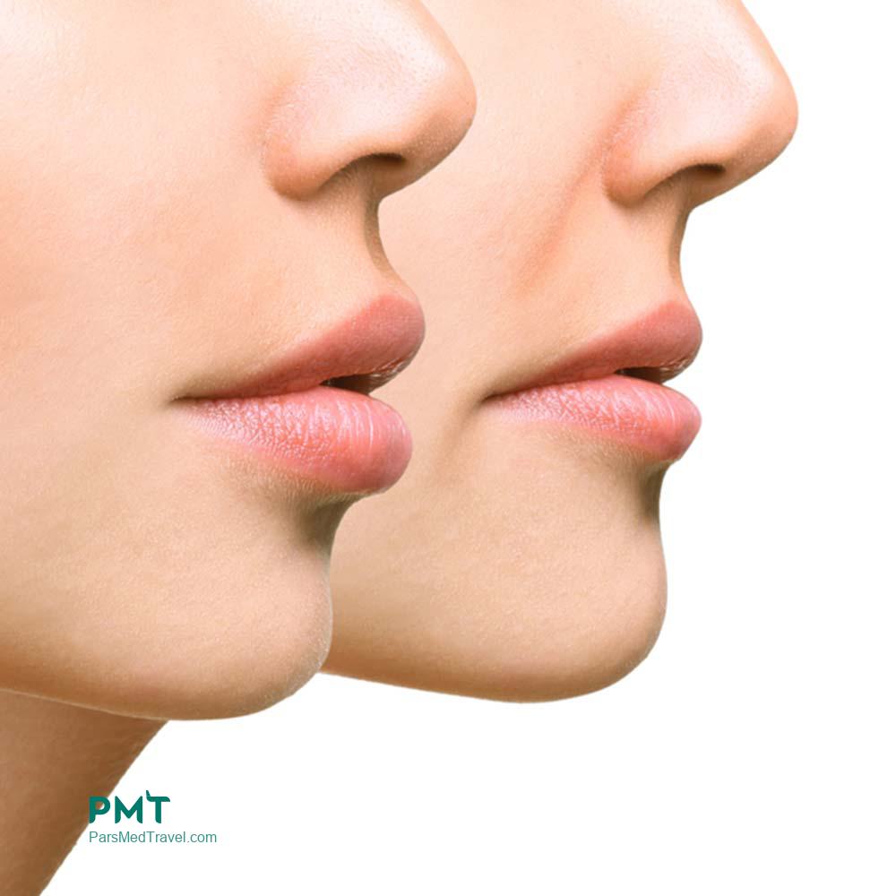Reveal your true beauty with mouth reduction surgery-pmt